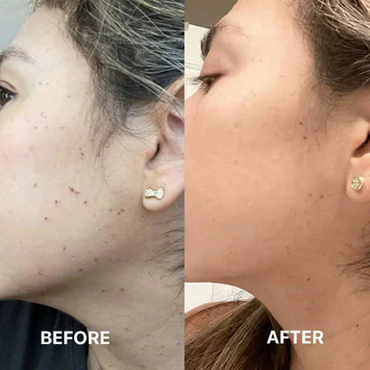 Fibroblast Plasma Pen | Skin Tag and Mole Removal